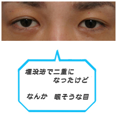 埋没法