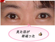 眼瞼下垂:見た目を若く見せる効果