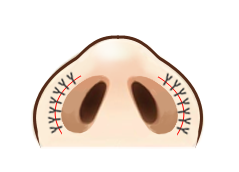 鼻孔縁挙上傷痕