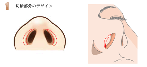 鼻孔縁挙上