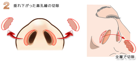 鼻孔縁挙上
