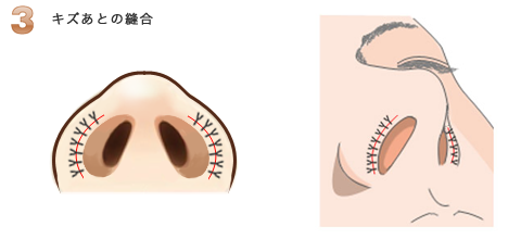 鼻孔縁挙上