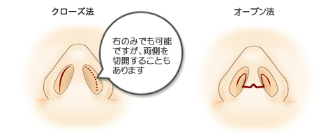 鼻短縮切開箇所