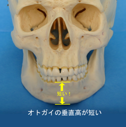 タイプⅡに加えてオトガイ部の垂直高が短いもの