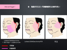 スプリングスレッド