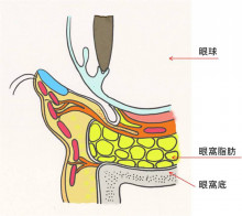 下眼瞼脱脂