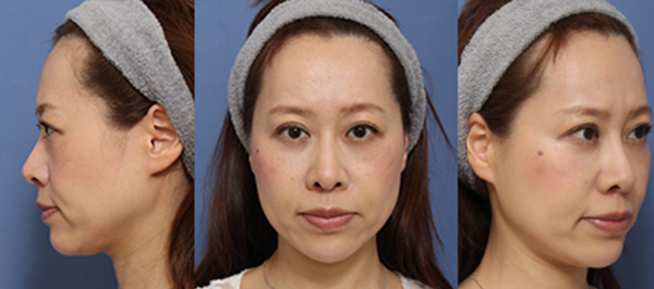 眉間ゴアテックス