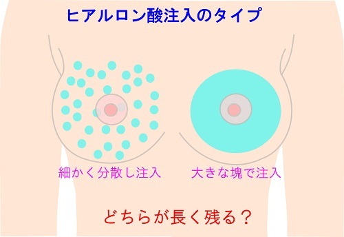 豊胸術