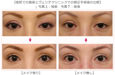 目 2 他院で眼瞼下垂3回 美容整形 美容外科のヴェリテクリニック 公式 東京 名古屋 大阪