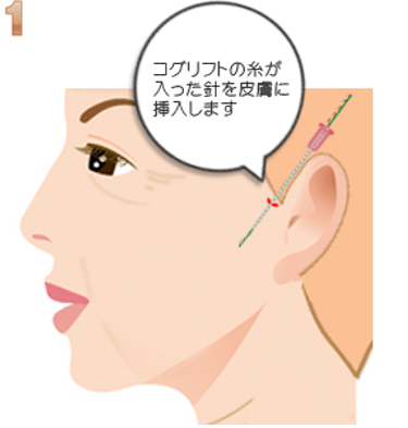 コグリフトの施術方法
