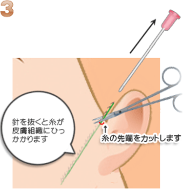 コグリフトの施術方法