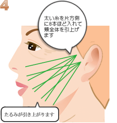 コグリフトの施術方法