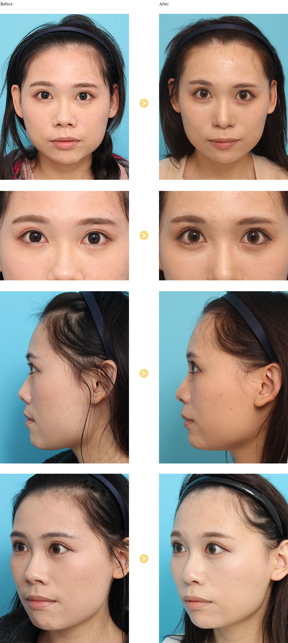 before_after