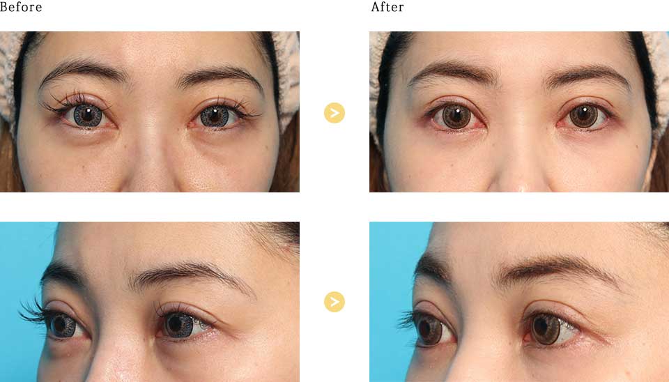 before_after