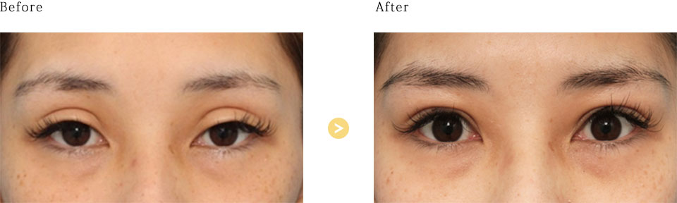 before_after