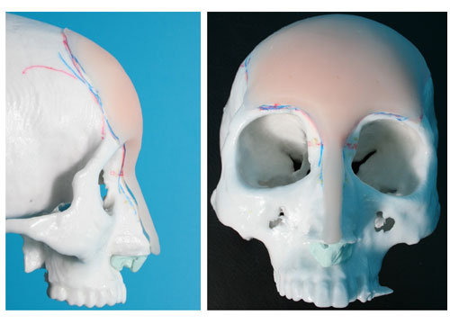 額と眉間と鼻筋のシリコンプロテーゼ