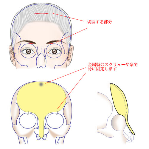 鼻中隔延長と隆鼻術を受けたけど