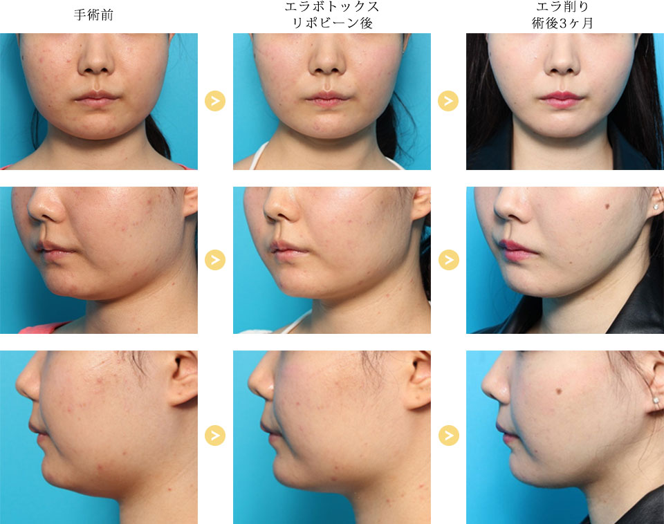 before_after