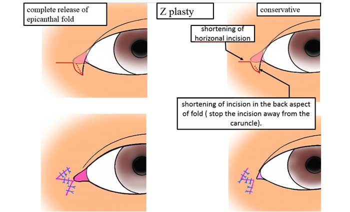 Z plasty