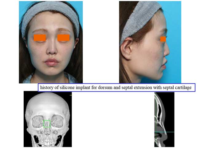 history of silicone implant for dorsum and septal extension with septal cartilage