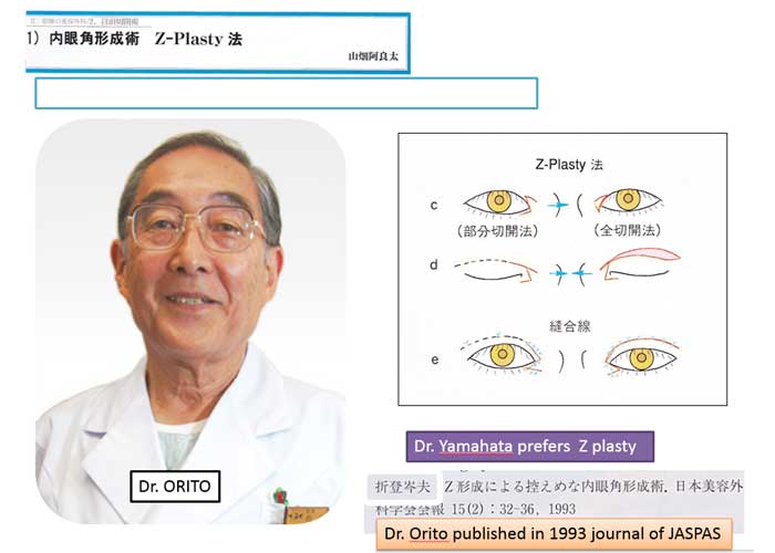 内眼角形成術　Z-Plasty法　Dr.ORITO