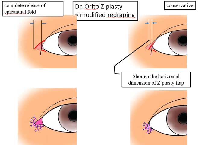 Dr. Orito Z plasty= modified redraping