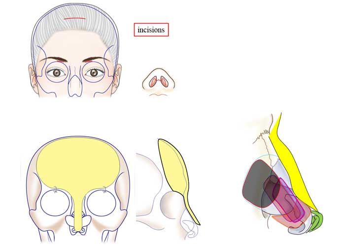 incisionsskull & nasal cartilage model