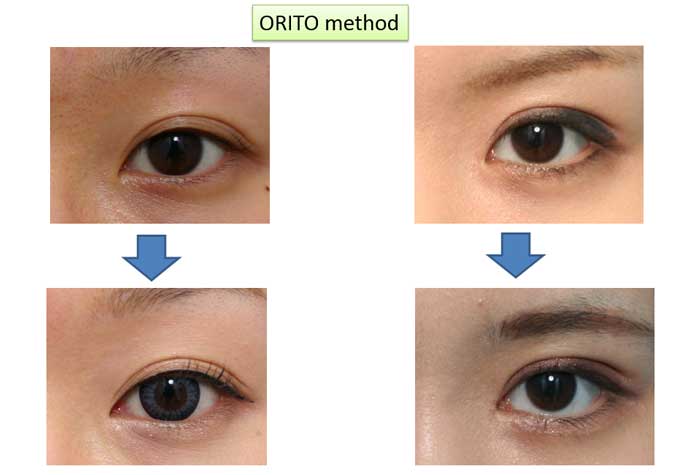 ORITO method