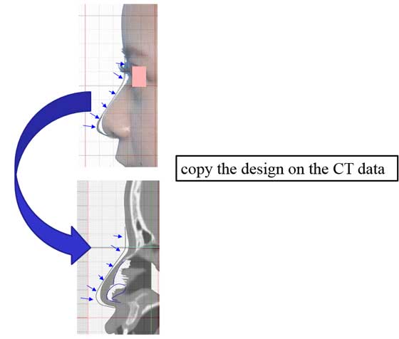 copy the design on the CT data