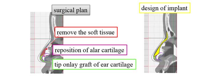 surgical plan