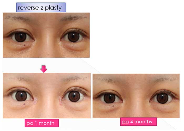 reverse z plasty po 1month,po 4maonth