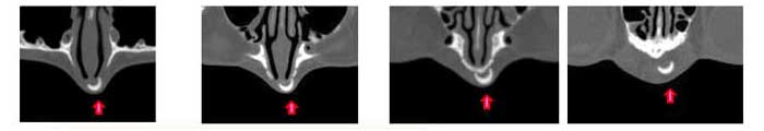 malposition of ready made implant