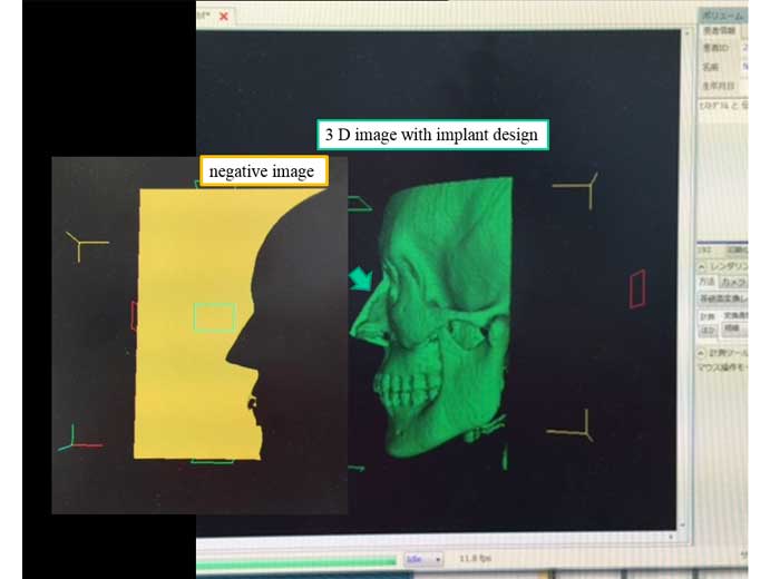 3 D image with implant design & negative image1
