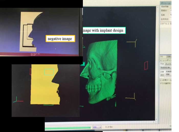 3 D image with implant design & negative image2