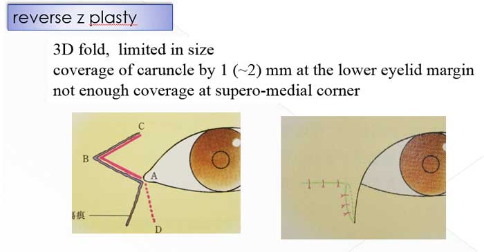 reverse z plasty2