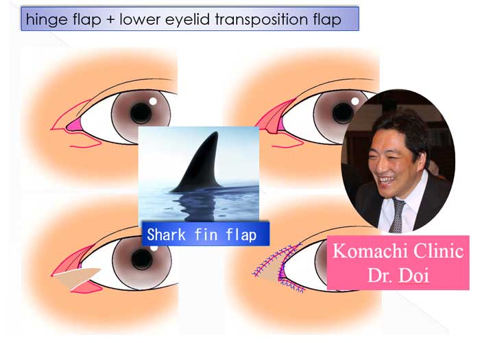 hinge flap + lower eyelid transposition flap