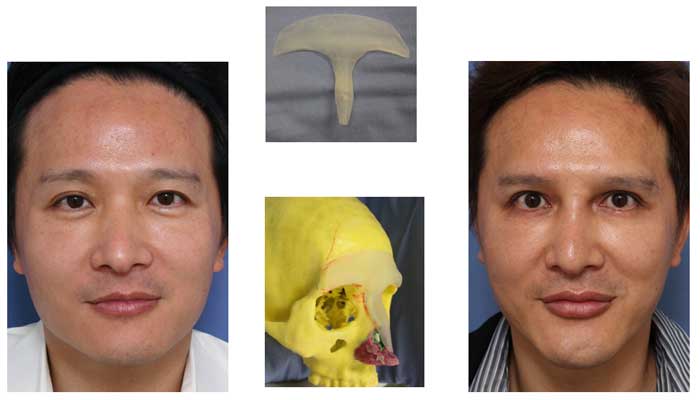 nose and extending glabella implant based on 3D printer model