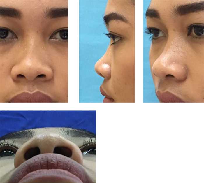 Rhinoplasty Masterclass Manila