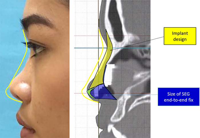 Rhinoplasty Masterclass Manila