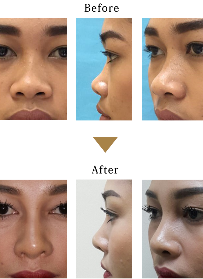 Rhinoplasty Masterclass Manila