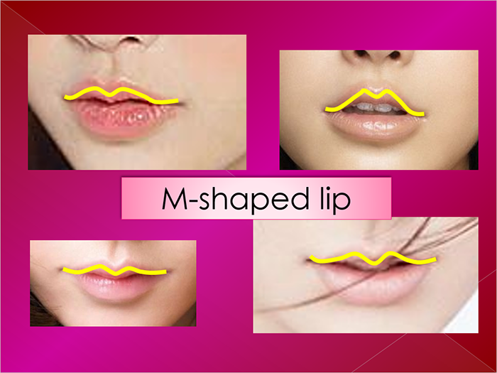 Lip plasty