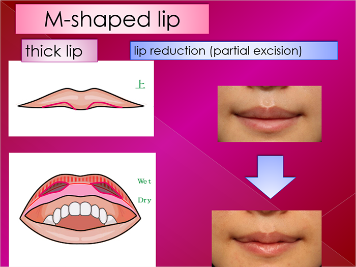 Lip plasty