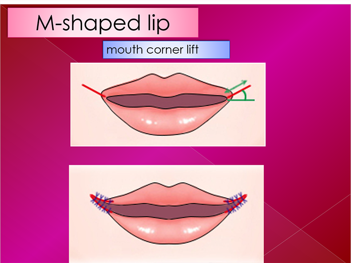 Lip plasty