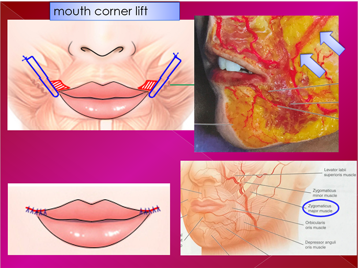 Lip plasty