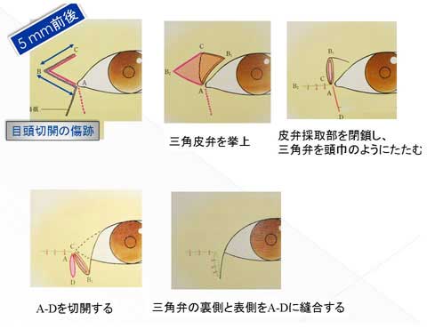 逆Ｚ法の術式の説明スライド