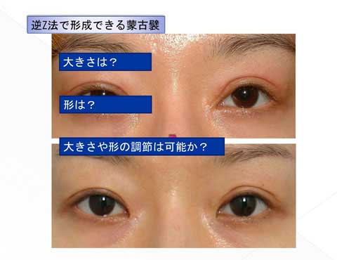 逆Ｚ法で形成できる蒙古襞の解説スライド