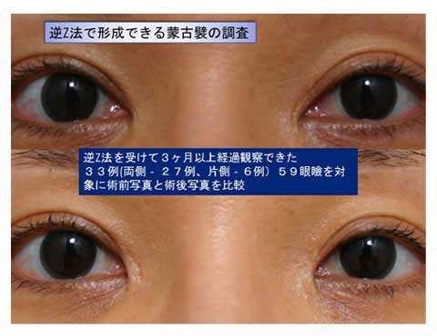 逆Ｚ法で形成できる蒙古襞の調査解説スライド