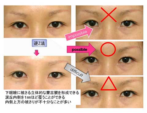 術後結果の考察