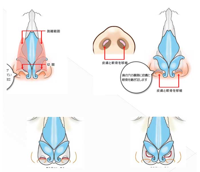 composite graft イラスト