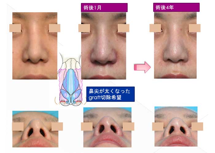 鼻尖が太くなったgraft切除希望